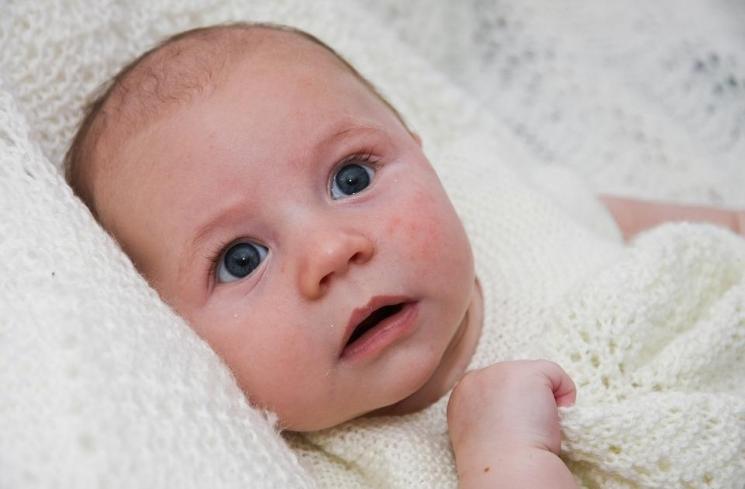 Dipegang banyak orang, pipi bayi ini terkena penyakit kulit berbahaya. (Pixabay)