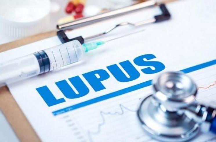 Penyakit lupus. (Shutterstock)